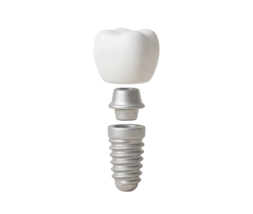 Dental implant